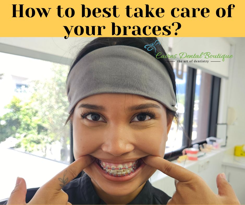 How to take care of your braces